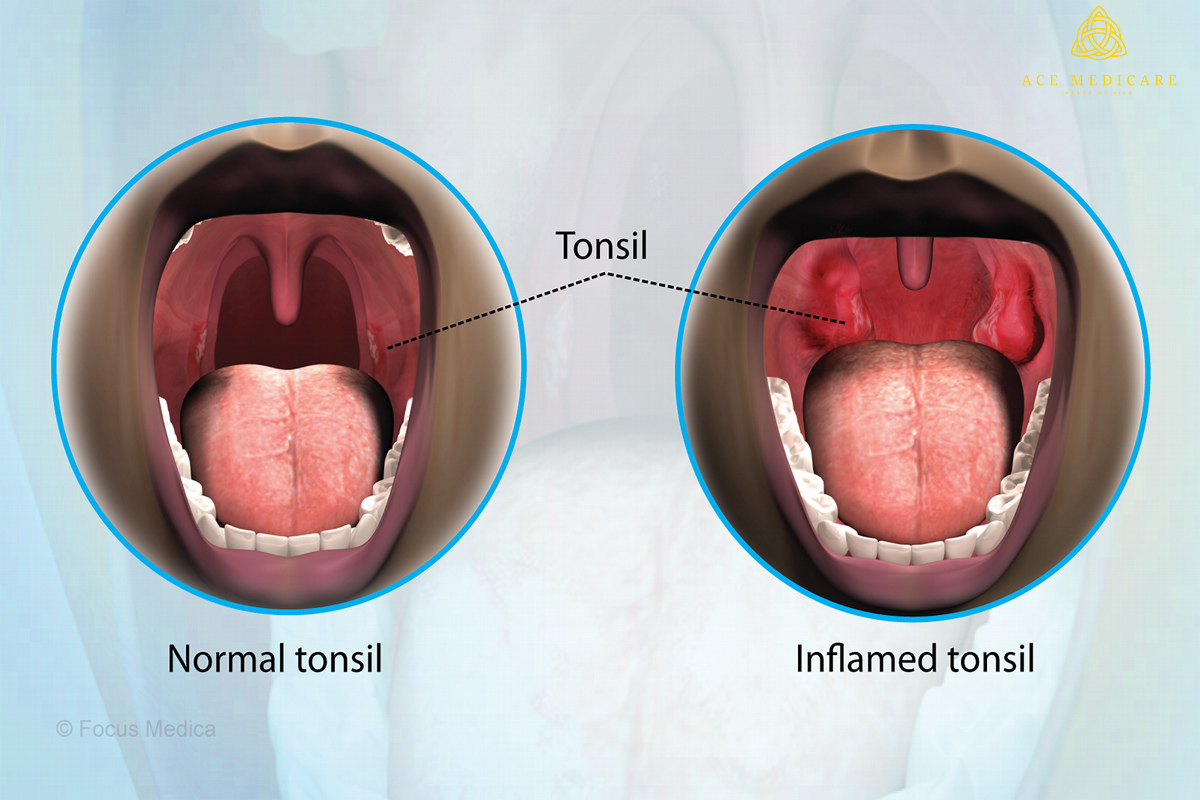 Tonsillitis and Its Impact on Oral Health: What You Should Be Aware Of
